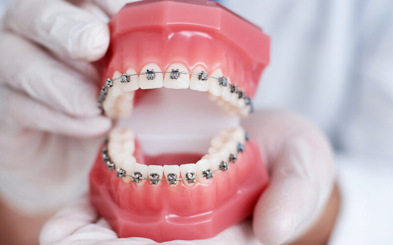 The Ultimate Guide to Understanding Different Types of Dental Braces
